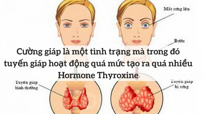 Cường giáp - Hình ảnh minh họa